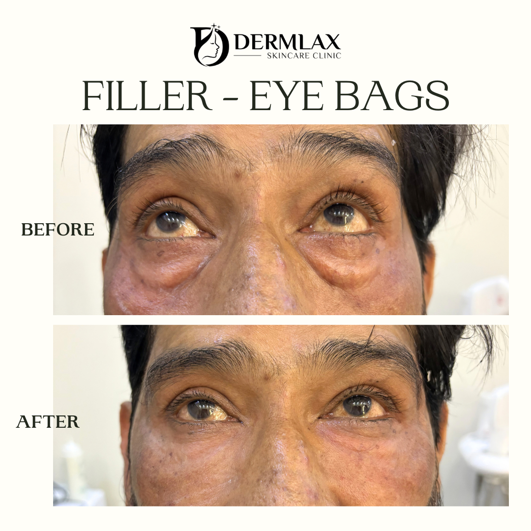 Filler – Eye bags before and after at Dermlax Skincare Clinic Karachi