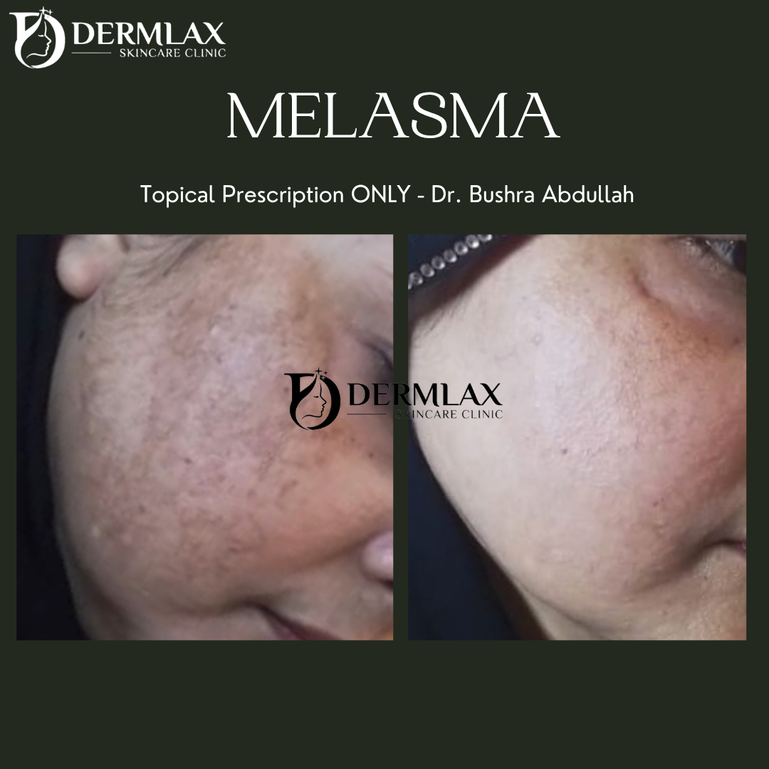 Melasma – Topical prescription treatment before and after at Dermlax Skincare Clinic Karachi