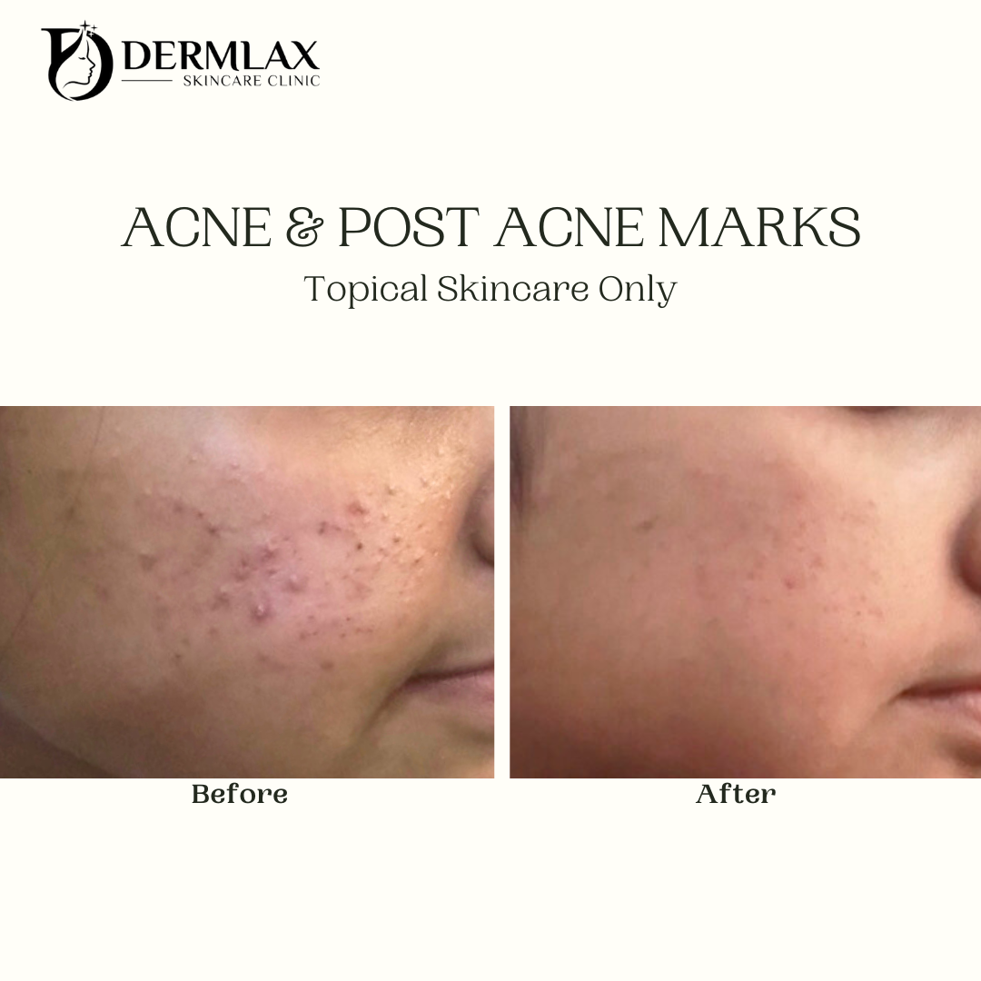Acne & Post Acne Marks – Topical skincare only before and after at Dermlax Skincare Clinic Karachi