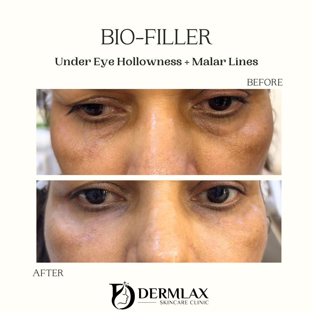 Bio Filler – Under-eye hollowness + malar lines before and after at Dermlax Skincare Clinic Karachi