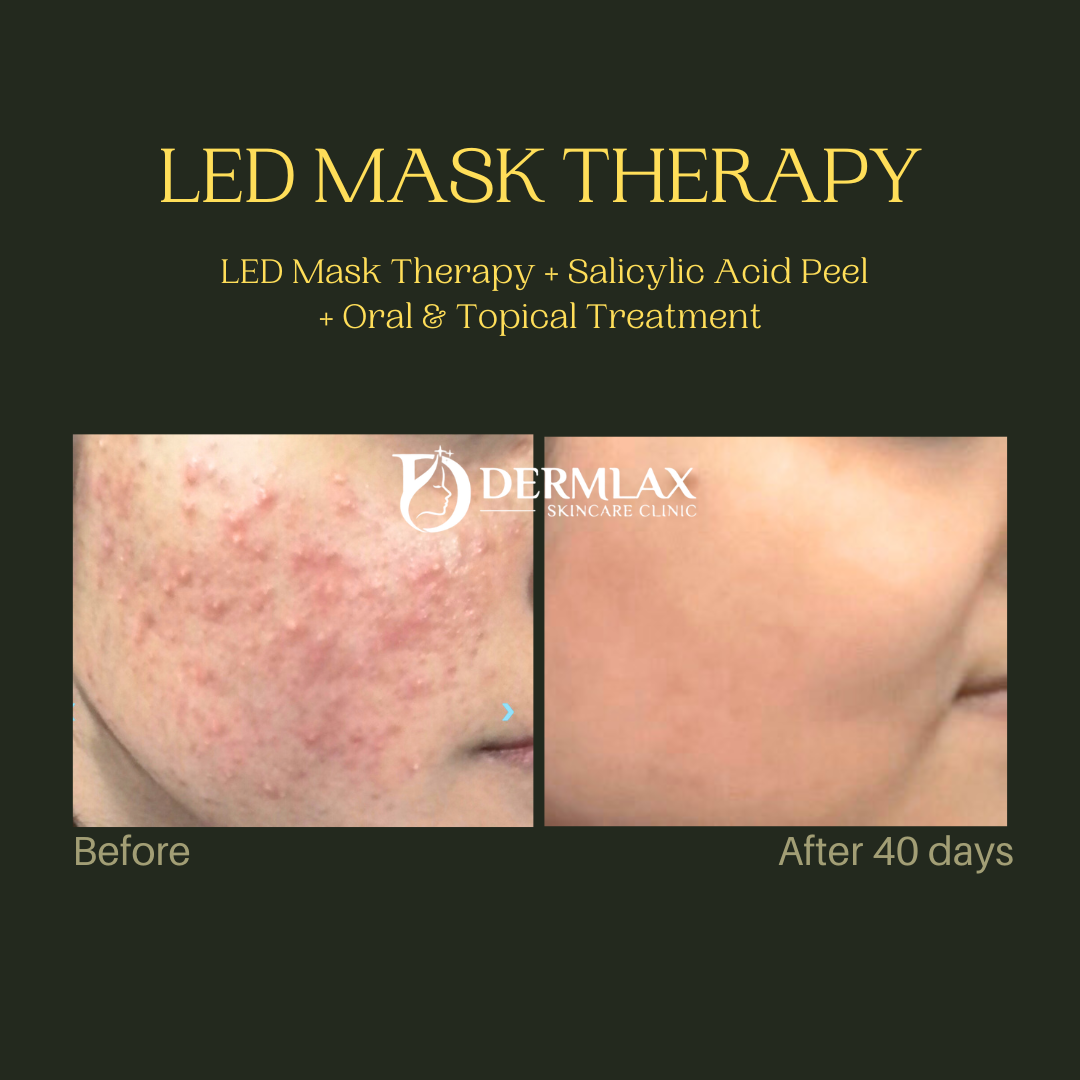 LED Mask Therapy – With salicylic peel + oral & topical treatment, after 40 days before and after at Dermlax Skincare Clinic Karachi