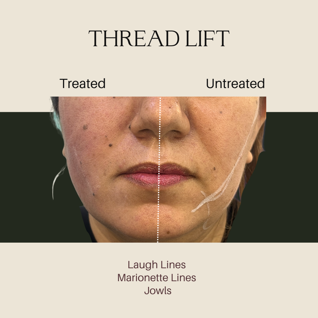 Thread Lift – Laugh lines, marionette lines & jowls (treated vs untreated) before and after at Dermlax Skincare Clinic Karachi