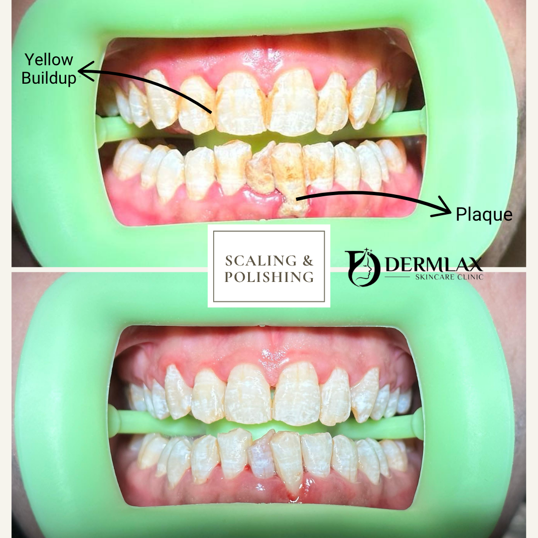 Scaling & Polishing – Yellow buildup & plaque removed before and after at Dermlax Skincare Clinic Karachi