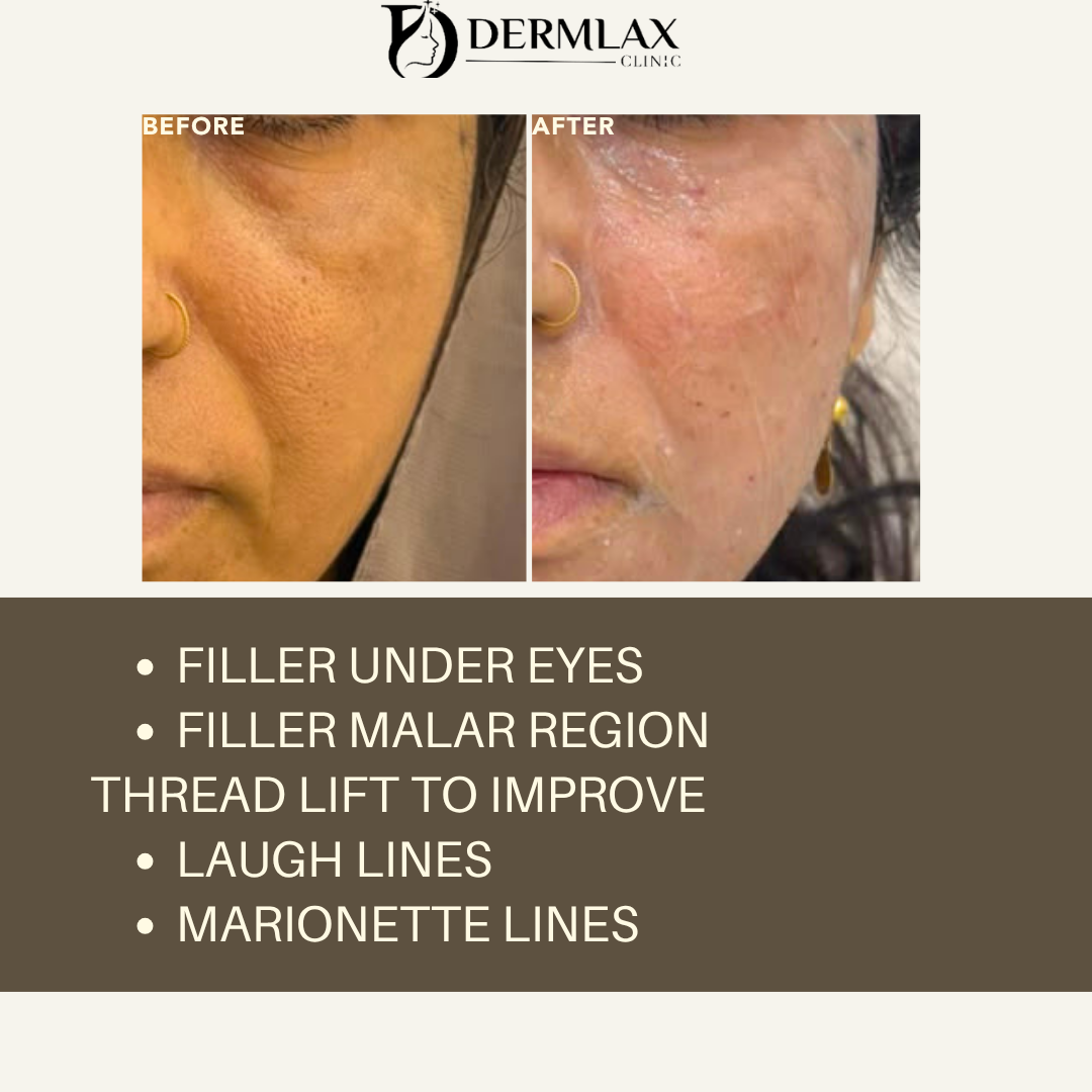 Filler + Thread Lift – Under eyes & malar filler, threads for laugh & marionette lines before and after at Dermlax Skincare Clinic Karachi
